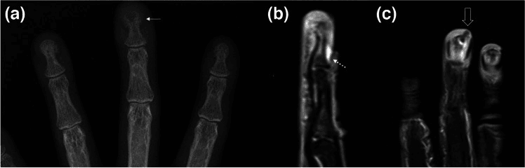 Finger radiograph (a) and MRI (b, c) of distal-phalanx osteomyelitis from periungual infection, arrows at the tip of the distal phalanx