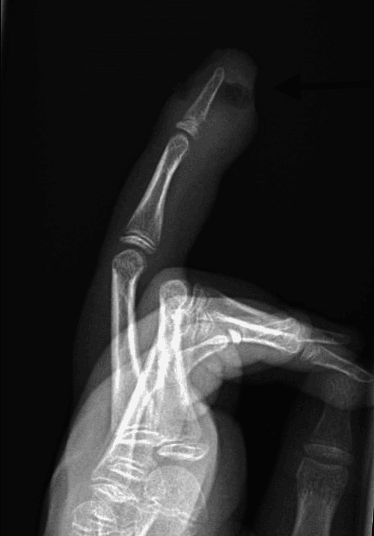 Lateral finger radiograph showing a distal soft-tissue defect after fingertip infection