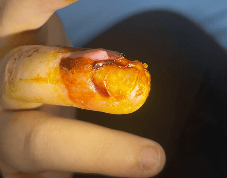Close-up of a child's fingertip showing tissue injury after drainage of distal phalanx infection