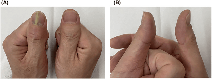 Frontal (A) and lateral (B) close-ups of both thumbs from a case of subungual abscess, the image-left thumb with a yellowish streak beneath the nail plate