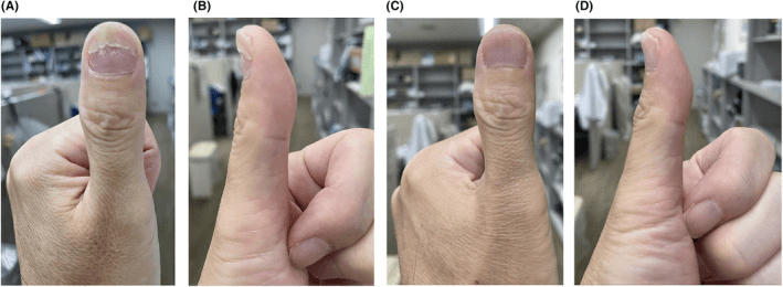 Frontal and lateral thumb photographs at two follow-up points (A to D), the nail regrown in the later pair
