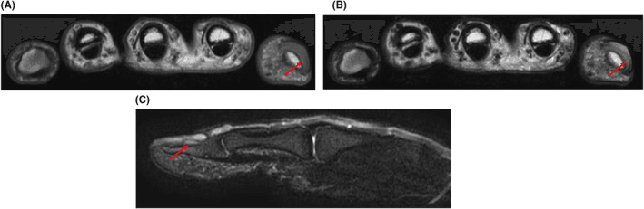 MRI of a subungual abscess: cross-sections through the digits (A, B) and a long-axis image of a digit (C), red arrows at the fingertip lesion