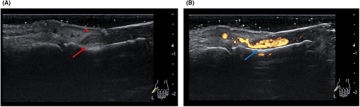 Grey-scale (A) and power Doppler (B) ultrasound of a subungual abscess, a red asterisk and red arrow in A and a blue arrow with colour-flow signal in B