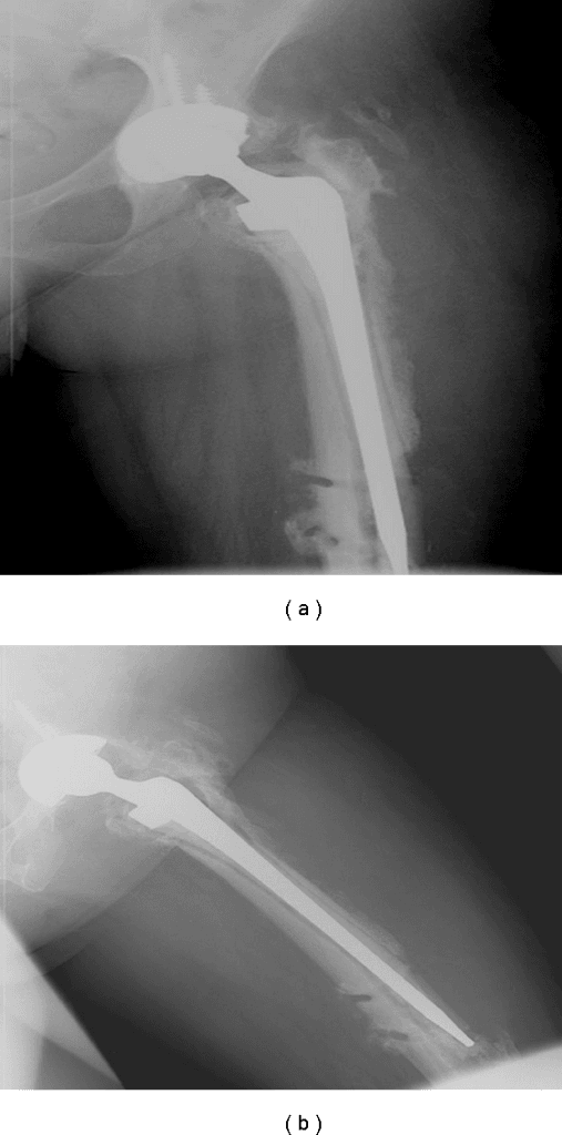 Two hip radiographs showing a subsided stem, deficient proximal femur and cortical perforation.