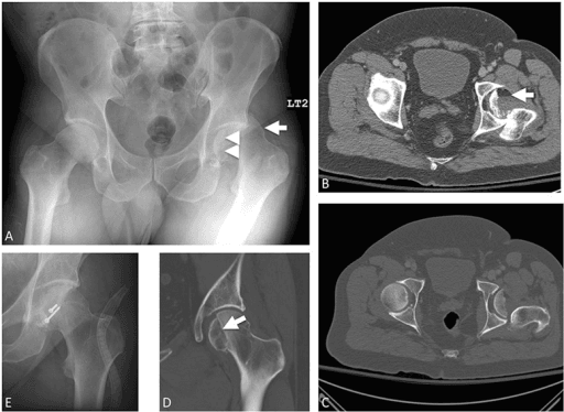 Multi-panel radiograph and CT of a Pipkin type IV femoral head fracture with posterior hip dislocation.