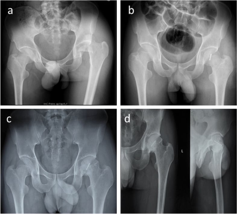 Pipkin Type II femoral head fracture with Herbert screw fixation and 7-year follow-up