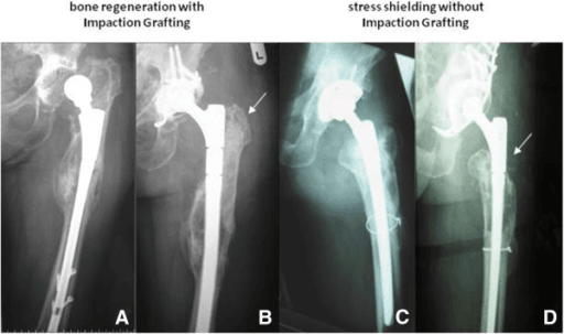 Paired preoperative and two-year postoperative hip radiographs showing a long modular revision femoral stem.