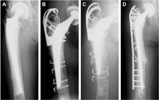 Anteroposterior hip radiograph showing a periprosthetic femoral fracture around a long-stemmed implant.