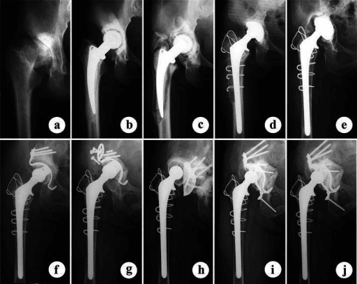 Series of anteroposterior pelvic radiographs showing a dysplastic arthritic right hip and subsequent hip replacement and revisions.