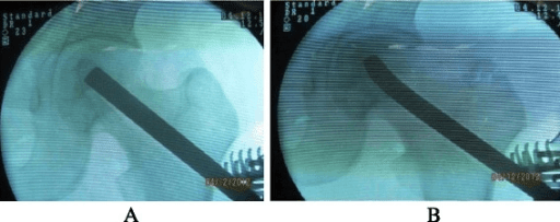 Two images demonstrating tightly impacted bone graft within the femoral canal.