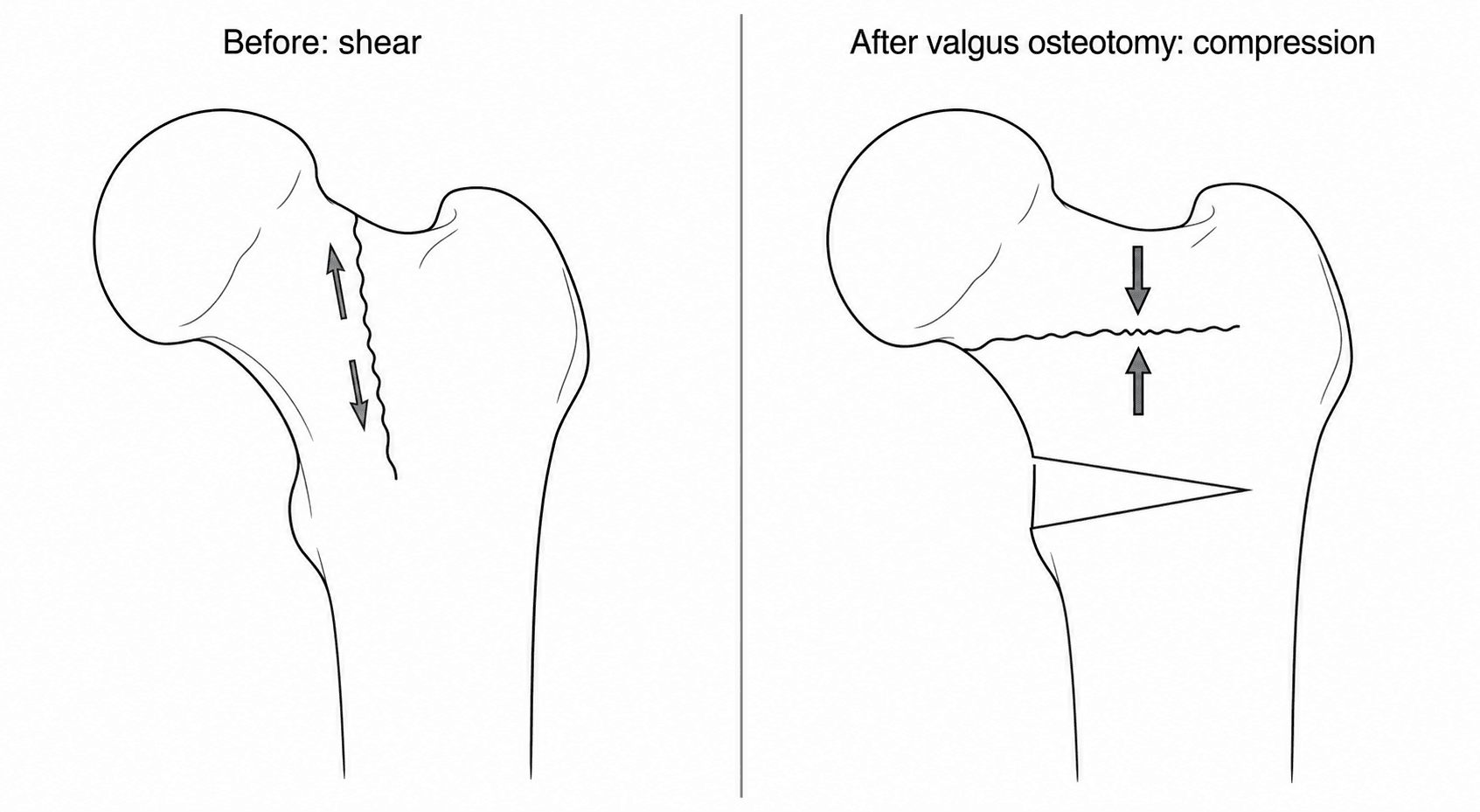 Two-panel diagram showing a vertical femoral neck fracture loaded in shear, and after valgus osteotomy loaded in compression