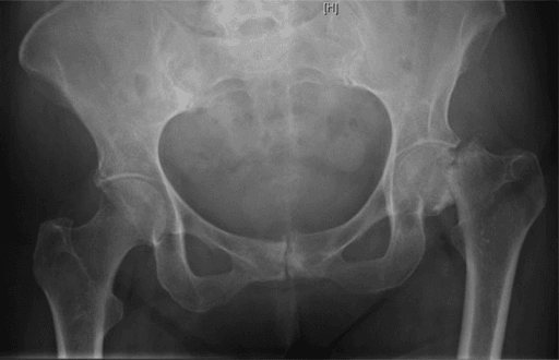 Anteroposterior pelvis radiograph in a patient with a missed femoral neck stress fracture showing both hip joints