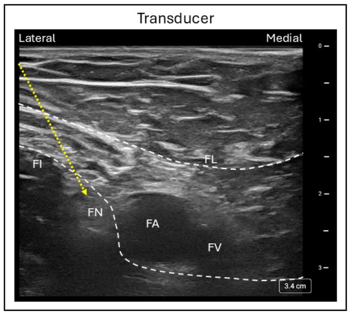 Ultrasound-guided femoral nerve block with the needle trajectory marked lateral to the femoral artery