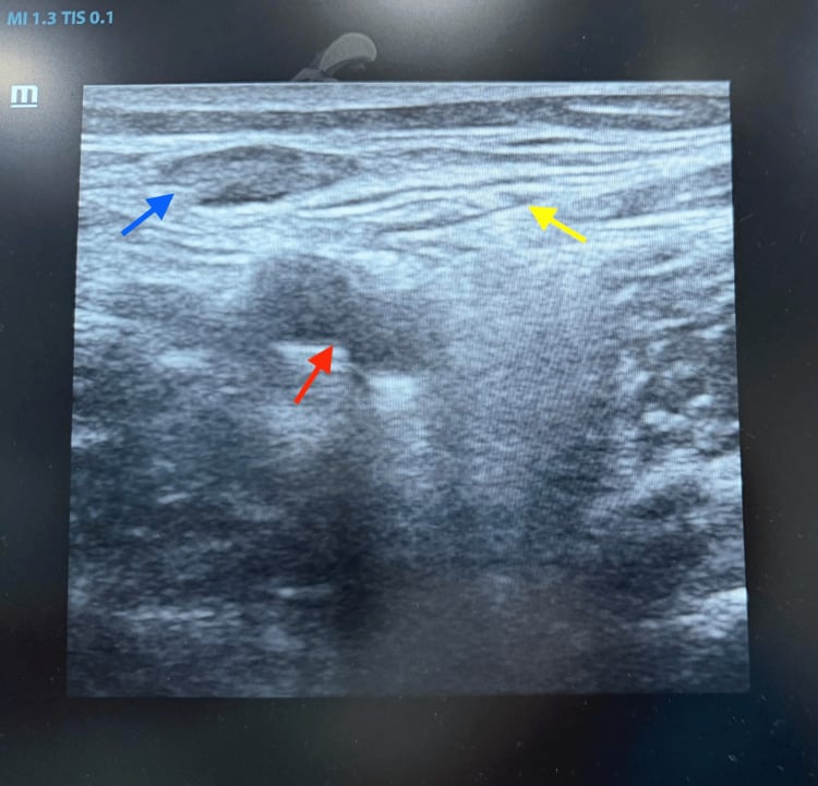 Annotated ultrasound of the femoral nerve lateral to the femoral artery and vein