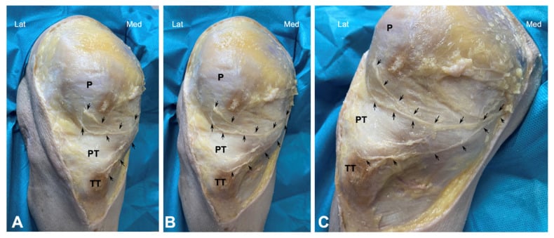 Cadaveric knee dissections showing variable infrapatellar branches of the saphenous nerve