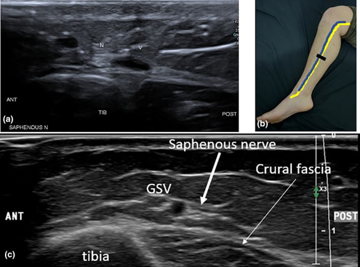 Ultrasound and schematic showing the saphenous nerve beside the great saphenous vein in the lower leg