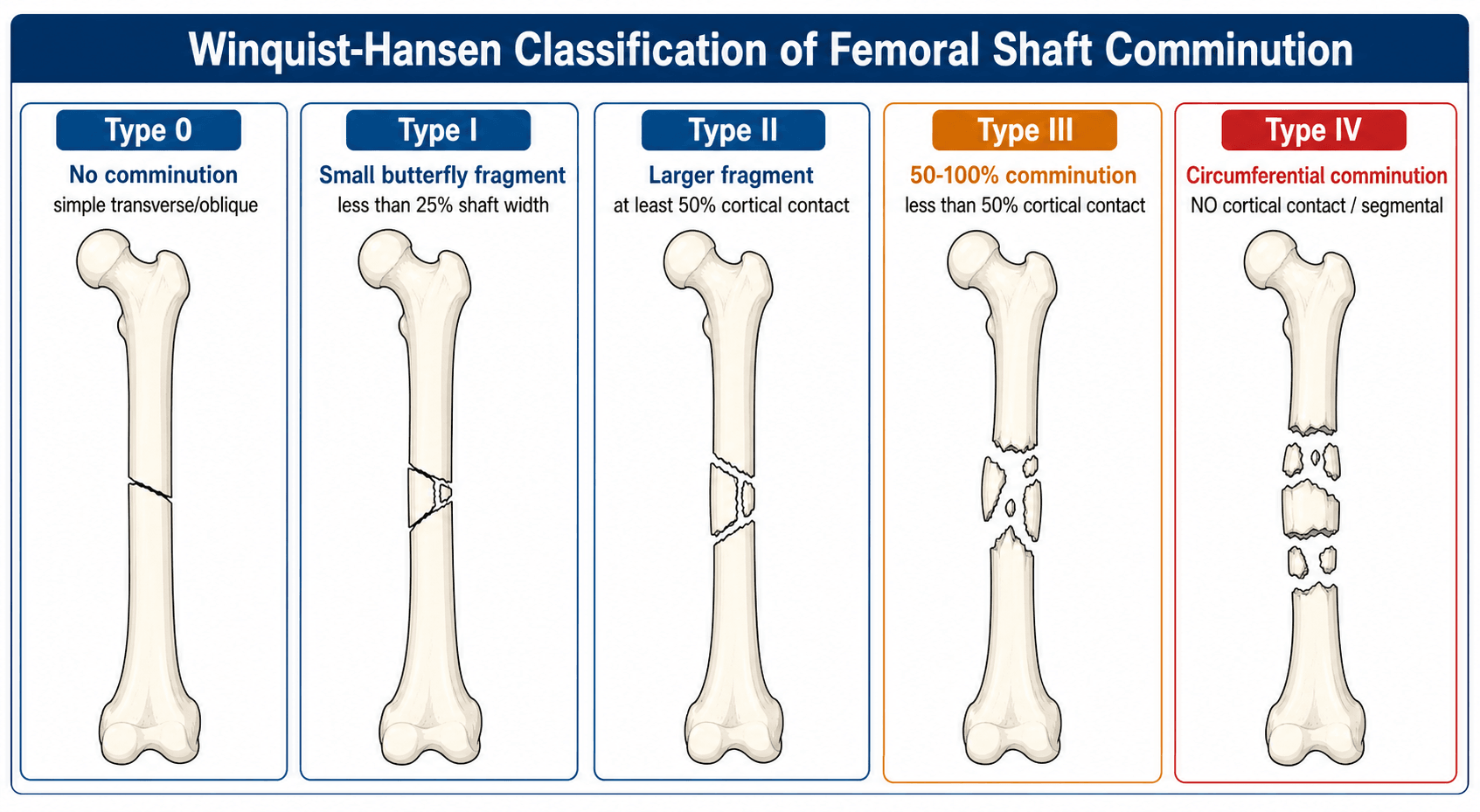 Winquist-Hansen classification of femoral shaft comminution