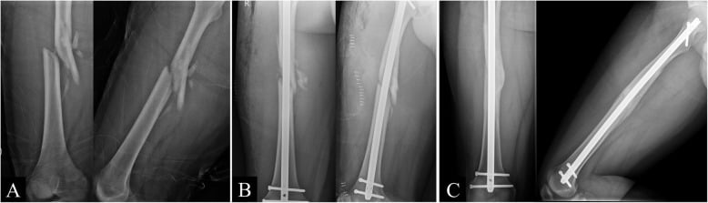 Comminuted femoral shaft fracture treated with IM nail and cerclage wiring