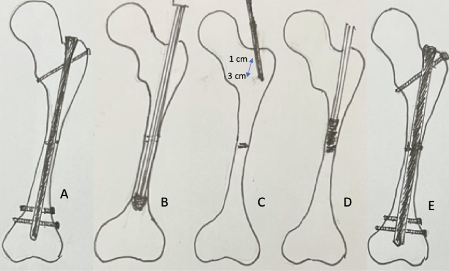 Exchange nailing technique diagram for femoral nonunion