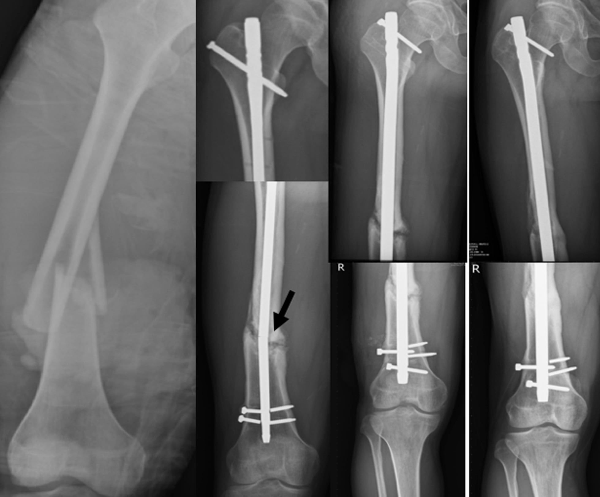 IM nail breakage complication in femoral shaft fracture