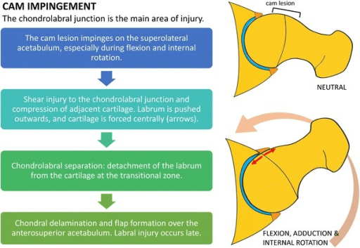 Mechanism diagram of cam impingement showing shear at the chondrolabral junction during flexion, adduction and internal rotation