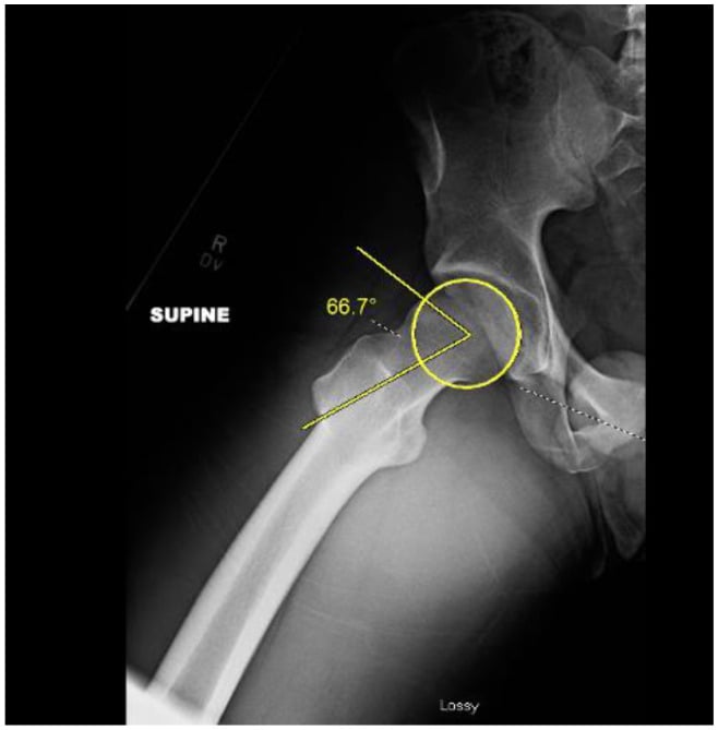 Dunn lateral hip radiograph with alpha angle construction measuring 66.7 degrees