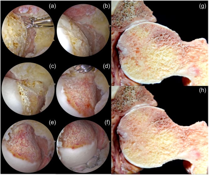Sequential arthroscopic and cadaveric views of cam osteochondroplasty restoring head-neck offset