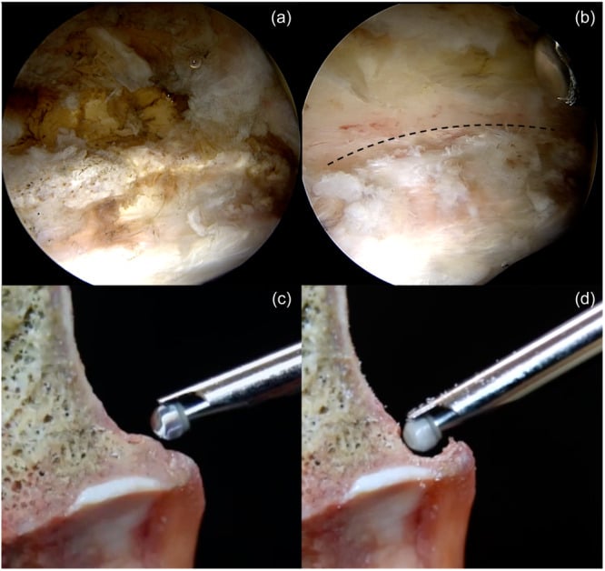Arthroscopic and cadaveric sequence of acetabular rim trimming for pincer impingement