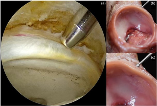 Arthroscopic and cadaveric views of the wave or bubble sign from cam-related acetabular cartilage delamination