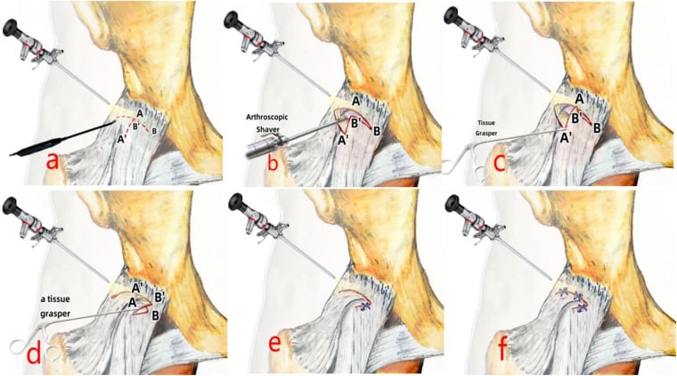 Six-step schematic of arthroscopic V-shaped hip capsular plication and reconstruction