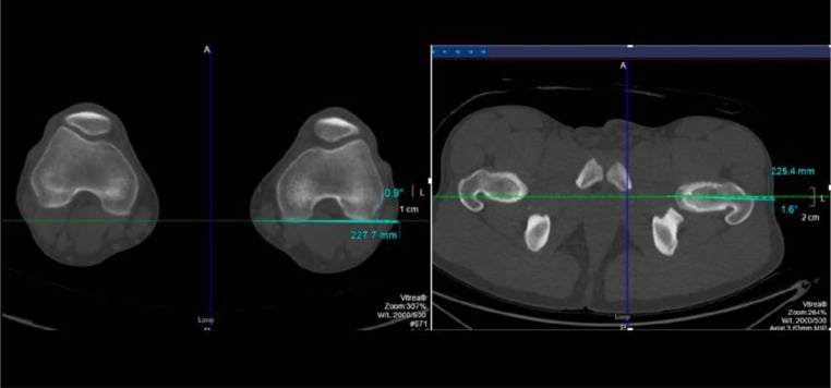 Axial CT rotational-profile images used to calculate femoral version from neck and distal condylar axes