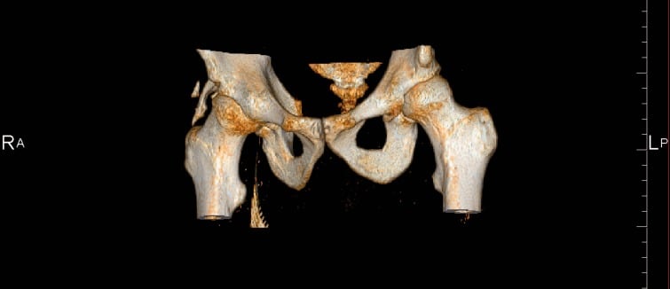 Three-dimensional CT reconstruction of grade 3 heterotopic ossification after hip arthroscopy