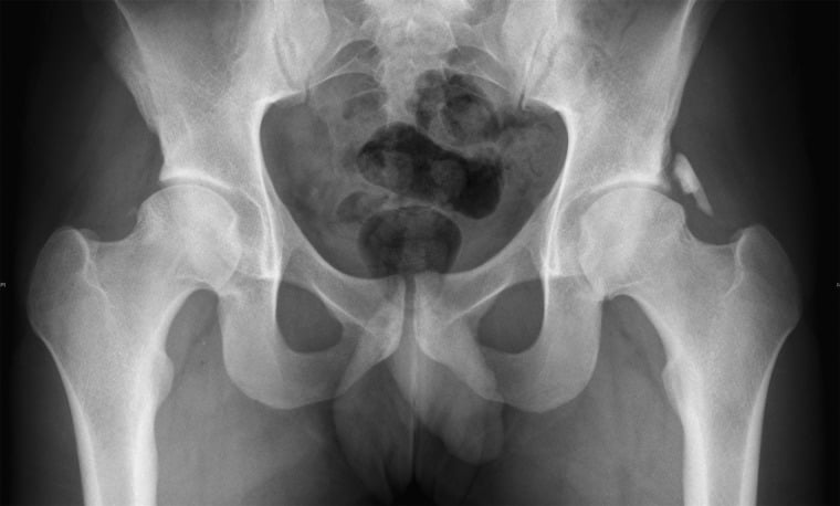 AP pelvis radiograph showing unilateral heterotopic ossification after hip arthroscopy