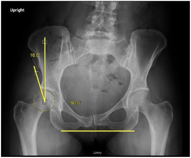 Standing anteroposterior pelvis radiograph with lateral centre-edge angle construction