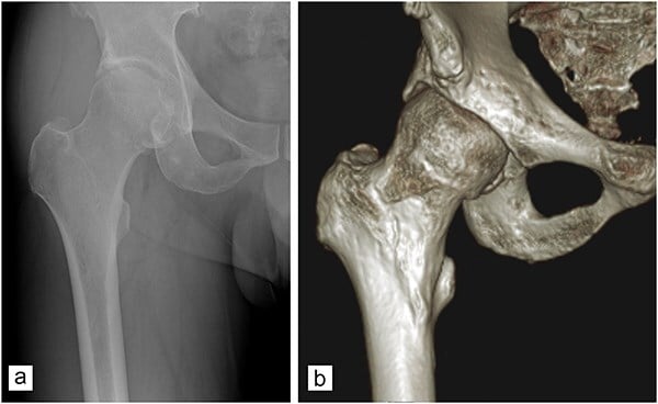 AP hip radiograph and three-dimensional CT reconstruction showing mixed femoroacetabular impingement morphology
