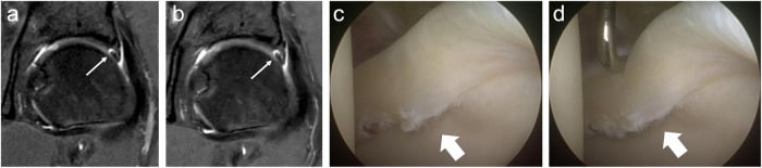 Coronal hip MRI and arthroscopic comparison demonstrating a full-thickness labral tear with chondrolabral separation