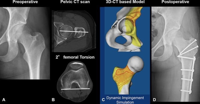 Radiograph, rotational CT and dynamic three-dimensional model of impingement caused by reduced femoral version