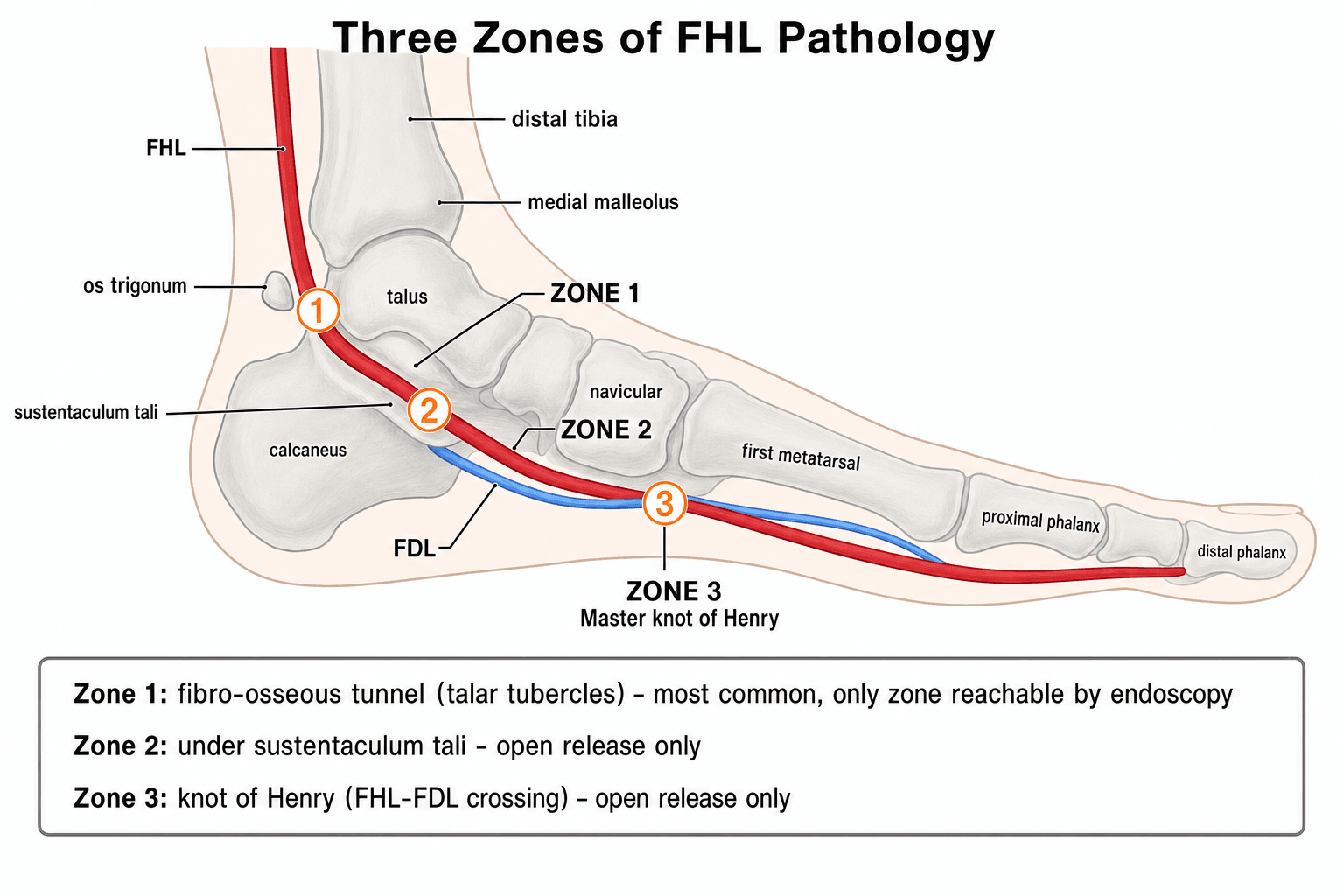 Medial view of the foot and ankle showing the flexor hallucis longus tendon course with the three anatomical zones of pathology labelled: Zone 1 at the posterior talus, Zone 2 at the sustentaculum tali, and Zone 3 at the knot of Henry.
