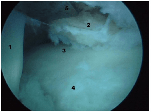 Endoscopic view of the posteromedial ankle showing scarring of the flexor hallucis longus tendon adjacent to the posterior talar process during hindfoot endoscopy