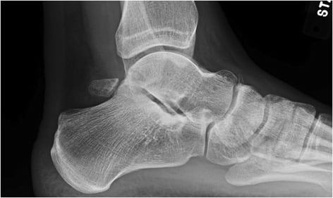 Lateral ankle radiograph showing a large os trigonum