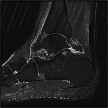 Sagittal fluid-sensitive ankle MRI showing reactive oedema around an os trigonum