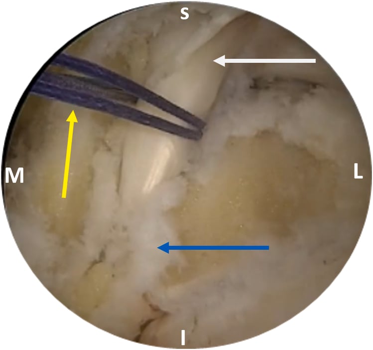Posterior endoscopic view identifying the flexor hallucis longus tendon and entrance to its fibro-osseous sheath
