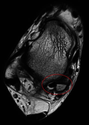 Axial T2 ankle MRI showing fluid around the flexor hallucis longus tendon, ringed in red, beside a chronic posteromedial talar fragment