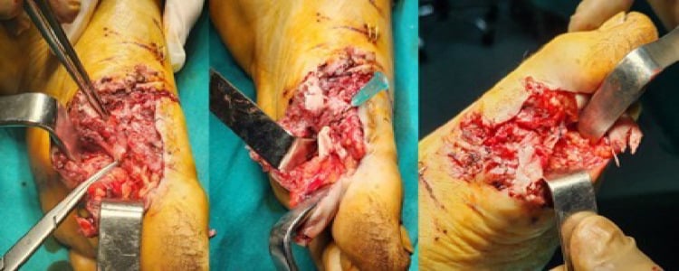 Three intraoperative photographs from open repair of a flexor hallucis longus tendon rupture