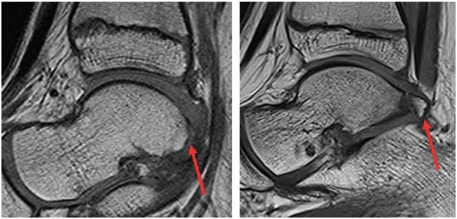 Paired sagittal ankle MRI comparing absence and presence of an os trigonum