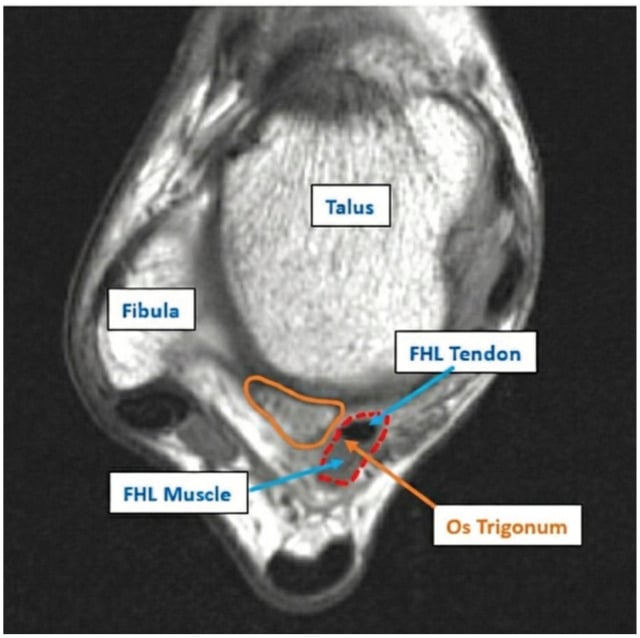 Axial ankle MRI outlining the os trigonum and adjacent flexor hallucis longus tendon and muscle