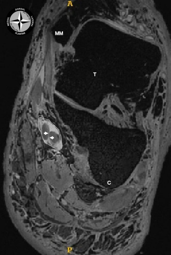 Coronal MRI at the knot of Henry showing the crossing flexor hallucis longus and flexor digitorum longus tendons