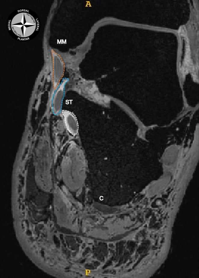 Coronal MRI showing the separate tendon sheaths at the sustentaculum tali with the flexor hallucis longus sheath outlined