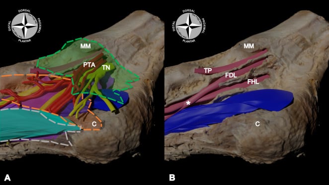 Three-dimensional tarsal tunnel models showing the tibial neurovascular bundle and flexor tendon sheaths