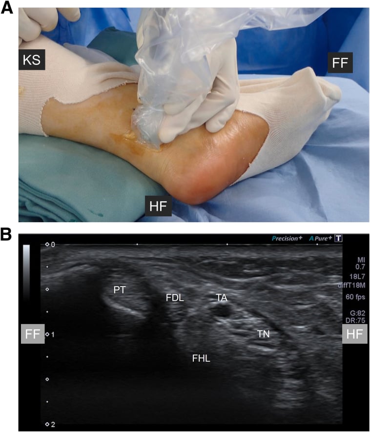 Ultrasound transducer on the medial ankle and the resulting image labelling the flexor tendons and tibial neurovascular bundle